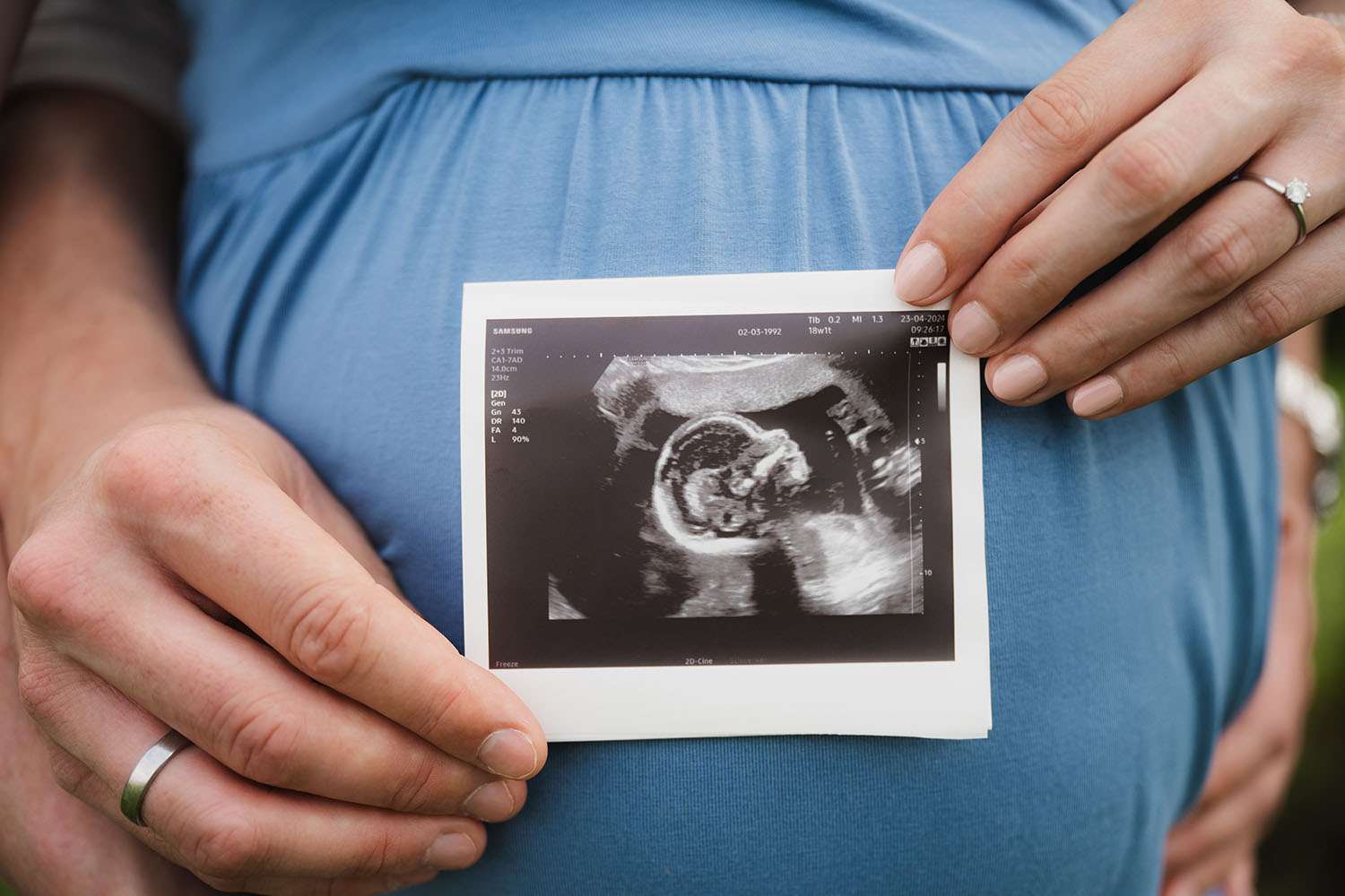 Ultraschallbild eines Babys